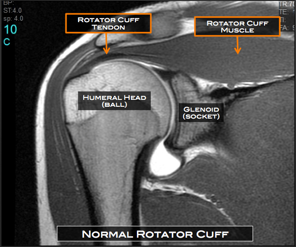 Torn rotator cuff mri image