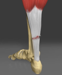 Achilles Tendon Rupture