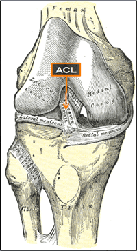 Anterior Cruciate Ligament (ACL) Injury