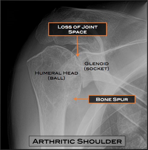 Shoulder Arthritis Austin, TX | Shoulder Surgery Austin, TX