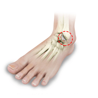 Osteochondral Lesions