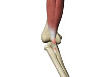 Biceps Tendon Repair