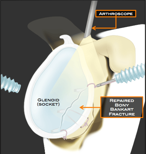 Bony Bankart Repair