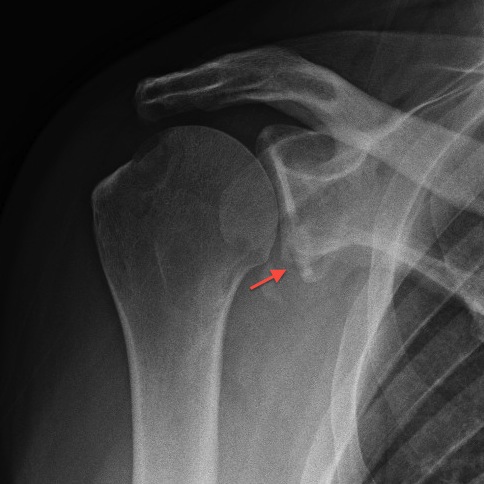 Shoulder Dislocation