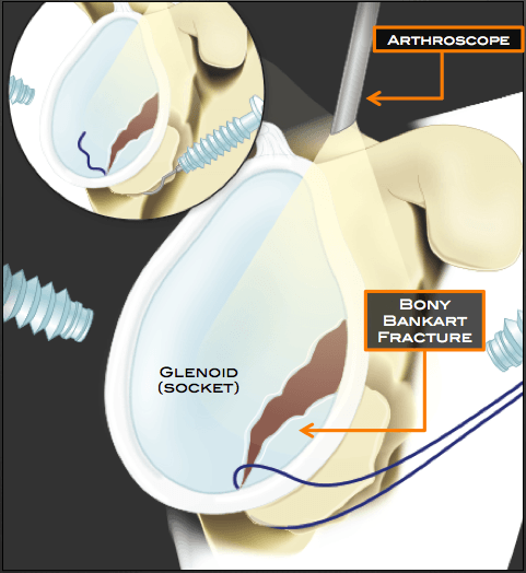 Bony Bankart Repair