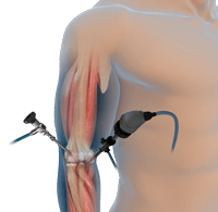 Elbow Arthroscopy