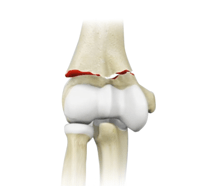 Elbow Fractures