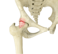 Femoro Acetabular Impingement