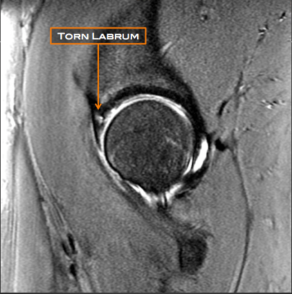 Labral Repair