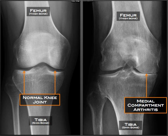 Medial compartment narrowing of knee