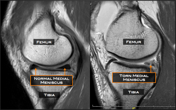 Torn Medial Meniscus Tear