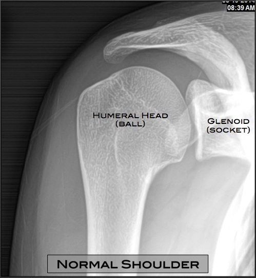 Shoulder Arthritis