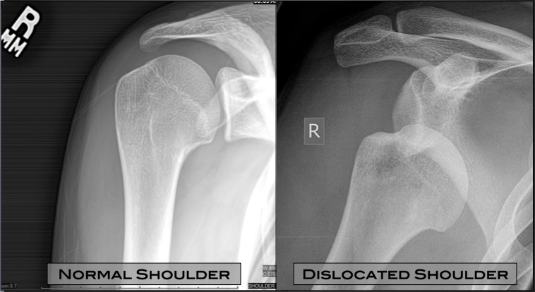 Shoulder Dislocation