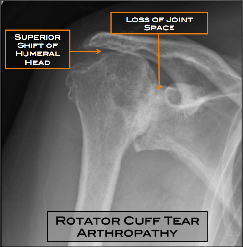 Shoulder Arthritis