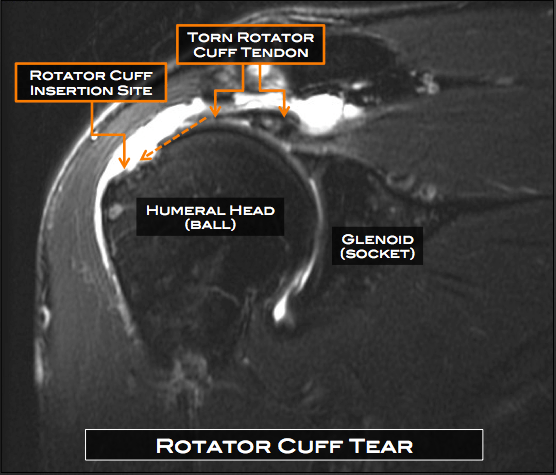 Rotator Cuff Tear