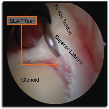 slap tear