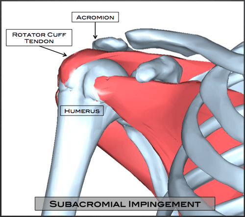 Subacromial Impingement