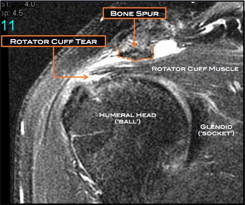 Subacromial Decompression